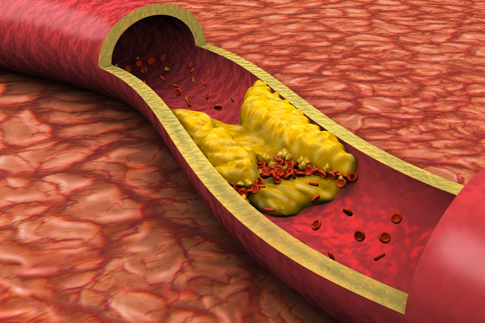 Dislipidemia 