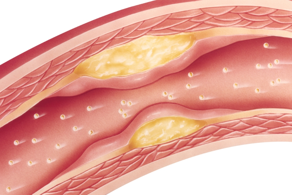 Dislipidemia 